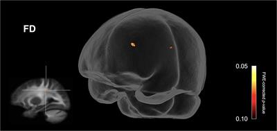 Fixel Based Analysis Reveals Atypical White Matter Micro- and Macrostructure in Adults With Autism Spectrum Disorder: An Investigation of the Role of Biological Sex